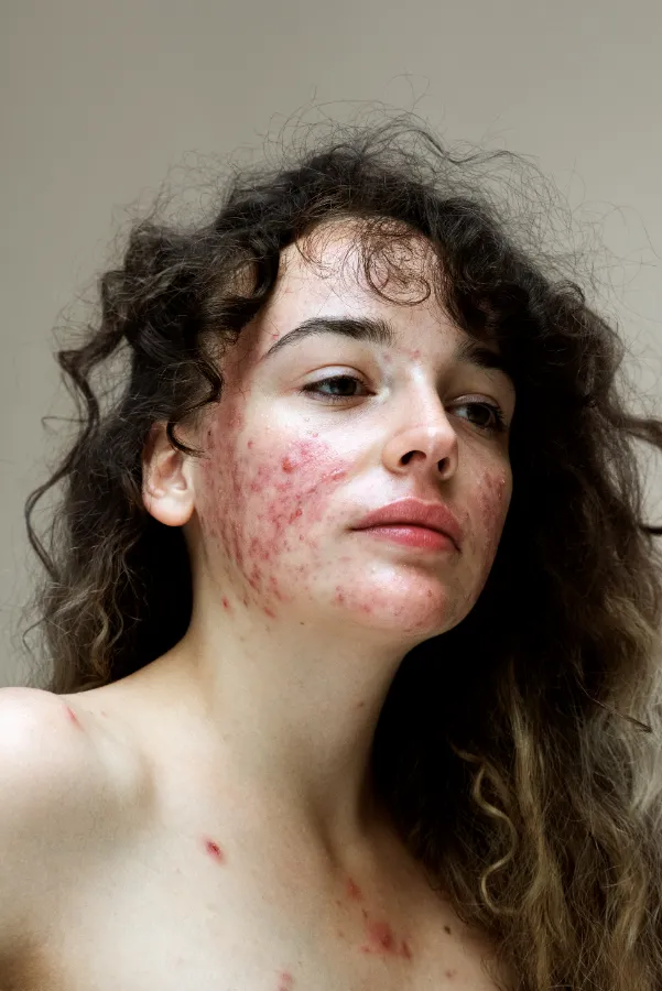 Epidermis project by Sophie